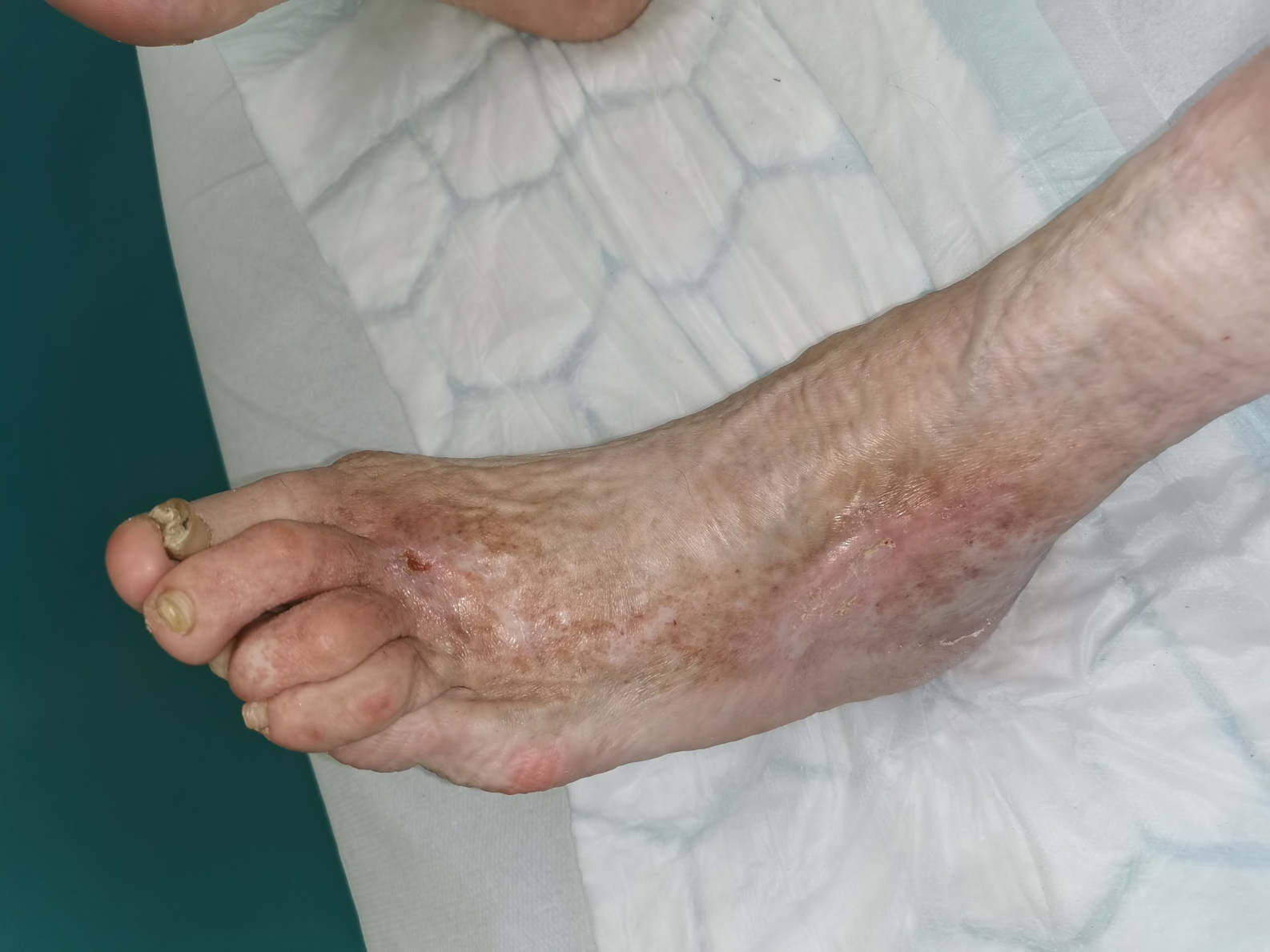 Laserski poseg na krčnih žilah je pospešil celjenje rane, kar se kaže z izboljšano kvaliteo življnja posameznika.