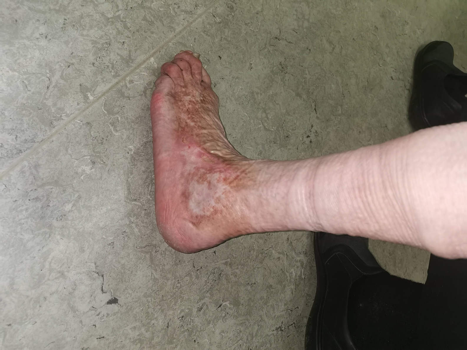 Odličen rezultat celjenja rane po laserskemu posegu na krčnih žilah.