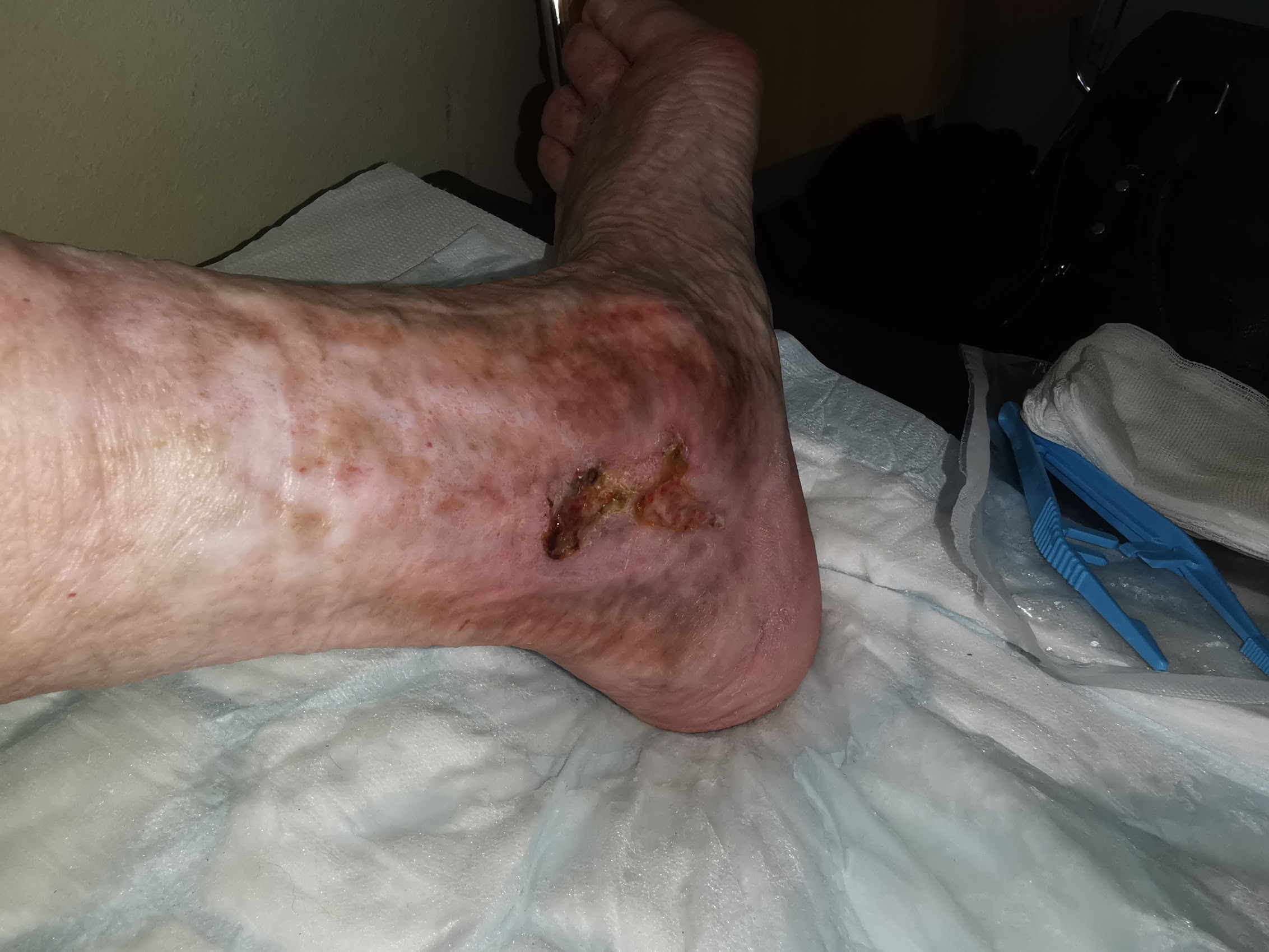 Z laserskim posegom na krčnih žilah omogočimo celjenje rane.