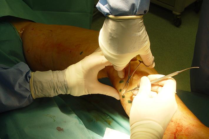Laserska operacija krčnih žil flebektomija