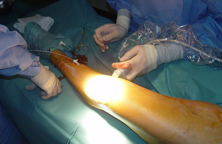 Laserska operacija krčnih žil