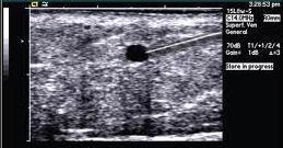 Sklerozacija krčnih žil ultrazvok