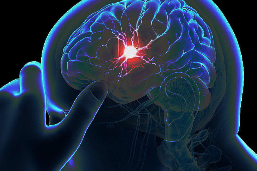Poskus novega načina nevromonitoringa med karotidnoendarteriektomijo z biokemičnim označevalcem možganske poškodbe S100B